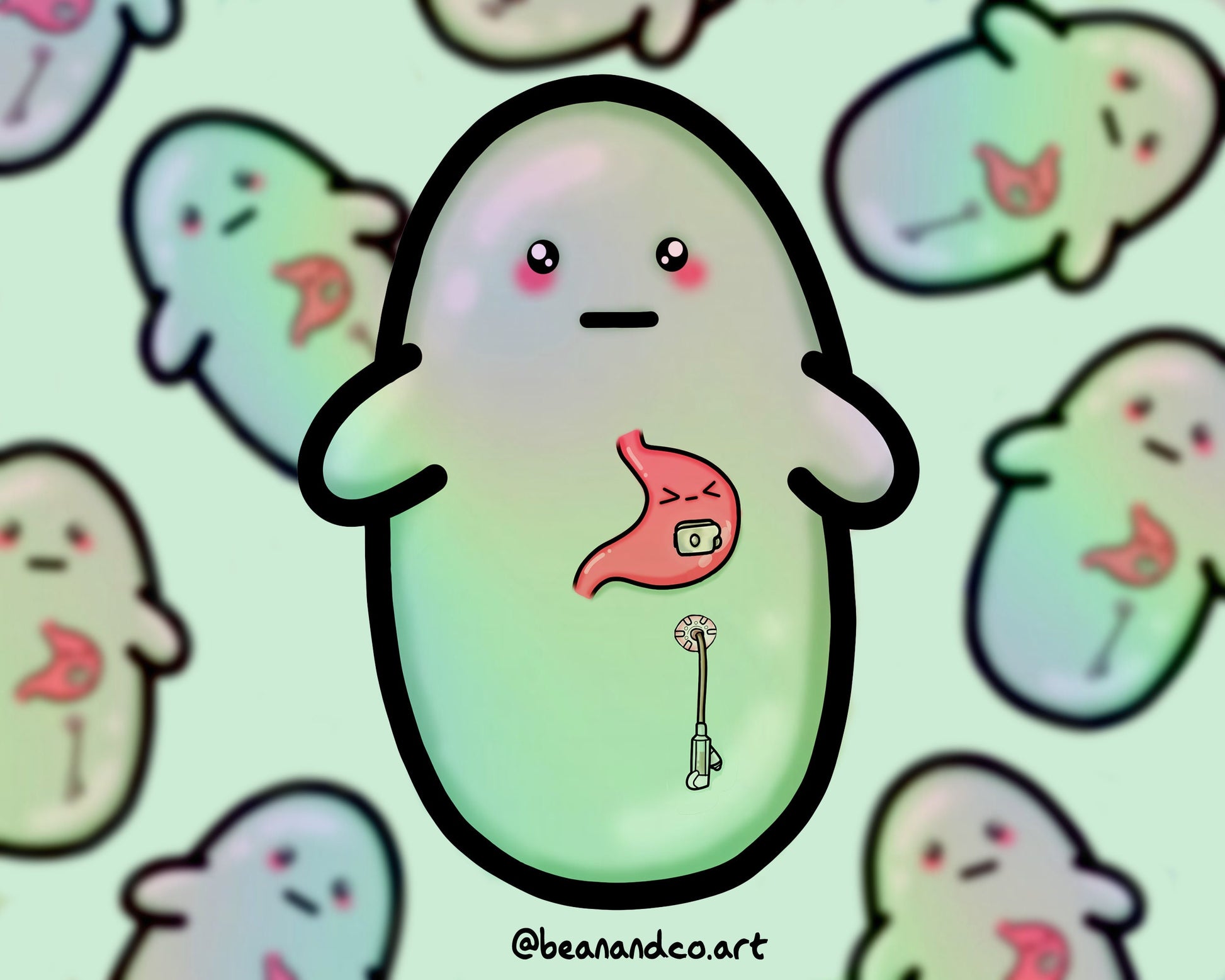 G tube button, J tube dangle bean sticker- 5cm rainbow holographic sticker- feeding tube awareness sticker- gastroparesis/ stomach problems